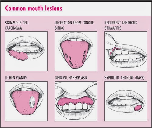 What causes mouth blisters?